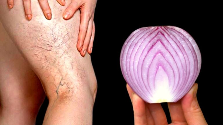 Scopri 5 rimedi naturali per eliminare le vene varicose definitivamente!