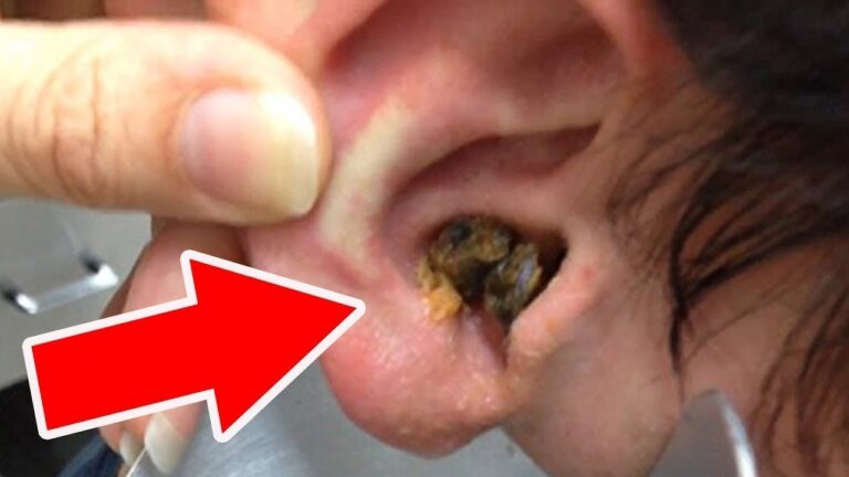 Elimina il cerume in eccesso in 10 minuti con questo trucco casalingo semplice!