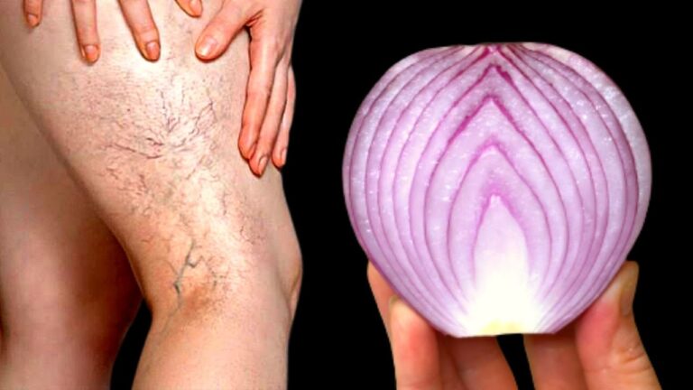 Scopri 5 rimedi naturali contro le varici e il dolore alle gambe!