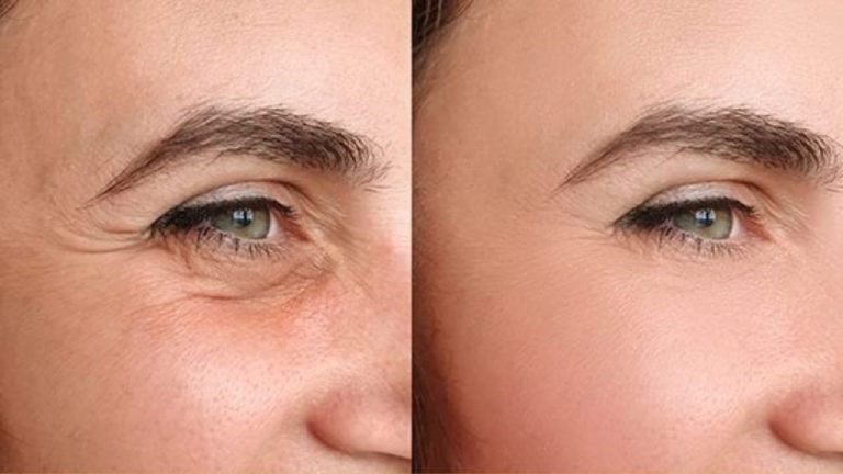 Questa crema naturale elimina le zampe di gallina in soli sette giorni