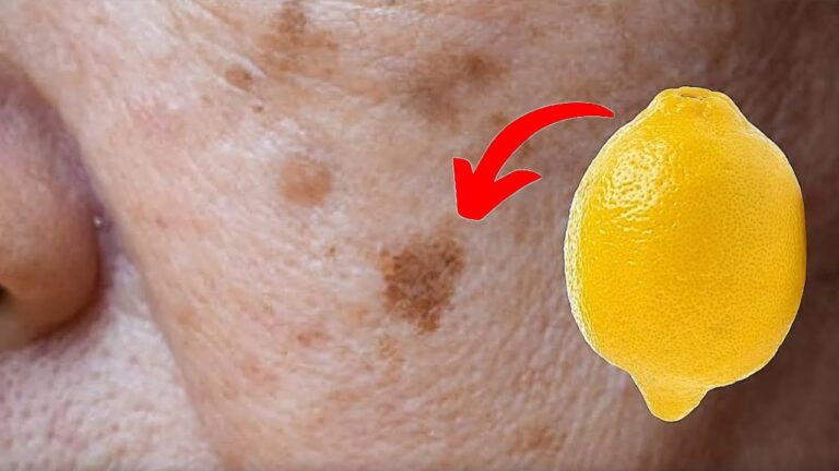 Scopri 5 metodi naturali per eliminare le macchie della pelle con il limone!