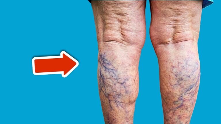 Scopri il miglior vitaminico per le varici: 1 soluzione sorprendente!