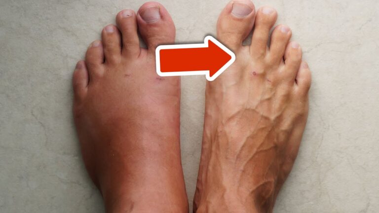 Scopri 5 vitamine per ridurre gonfiore a gambe, caviglie e piedi in modo naturale!